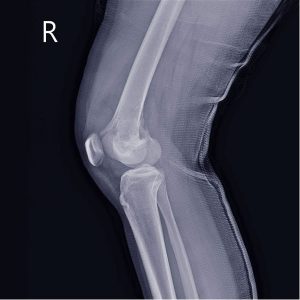 Які методи виявляють хондросаркому?