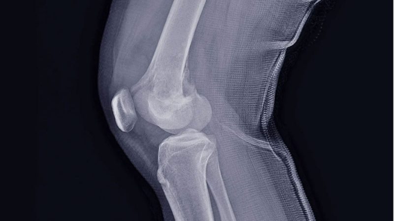 Які методи виявляють хондросаркому?