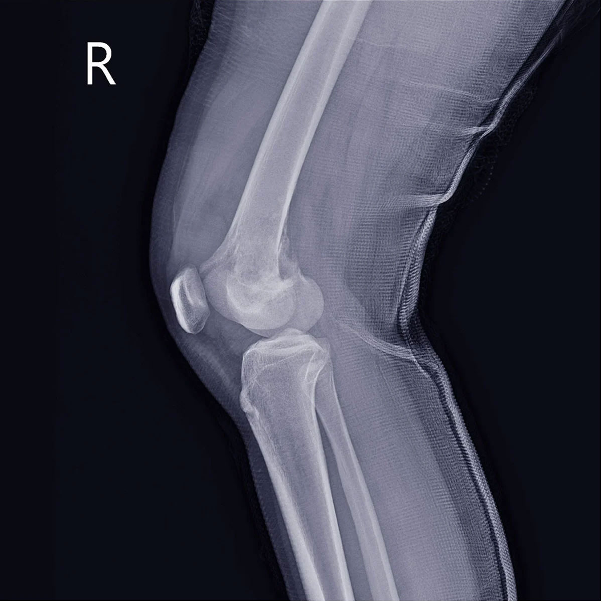 Які методи виявляють хондросаркому?